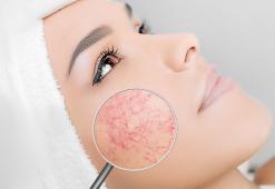 Куперозна кожа: симптоми, лечение, козметични продукти